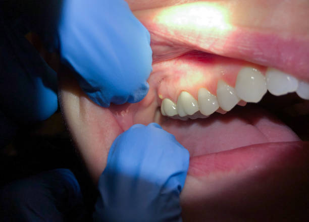 Best Emergency Dental Care for Broken or Chipped Teeth in Beresford, SD