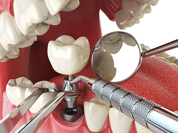 Best Emergency Treatment for Dental Infections or Abscesses in Beresford, SD